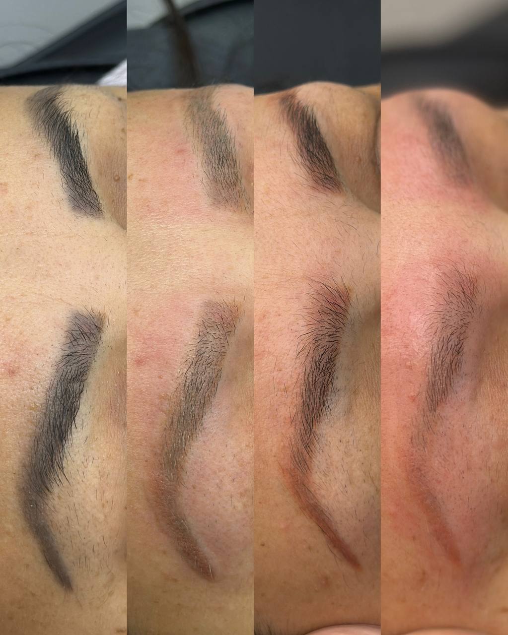 Tattoo & PMU Removal — Laser