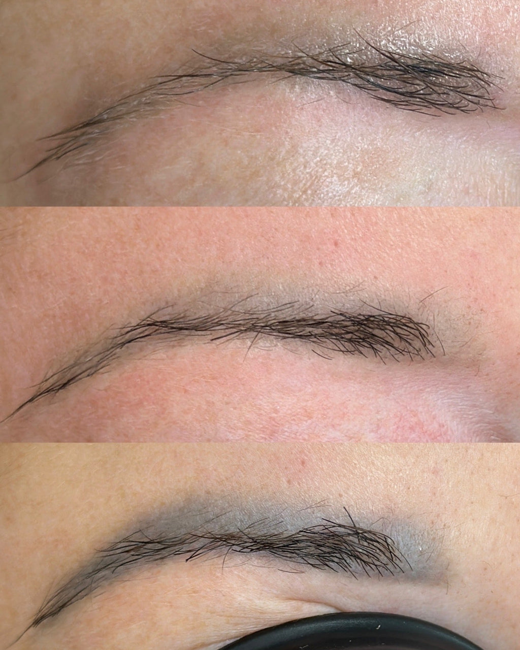 Tattoo & PMU Removal — Laser