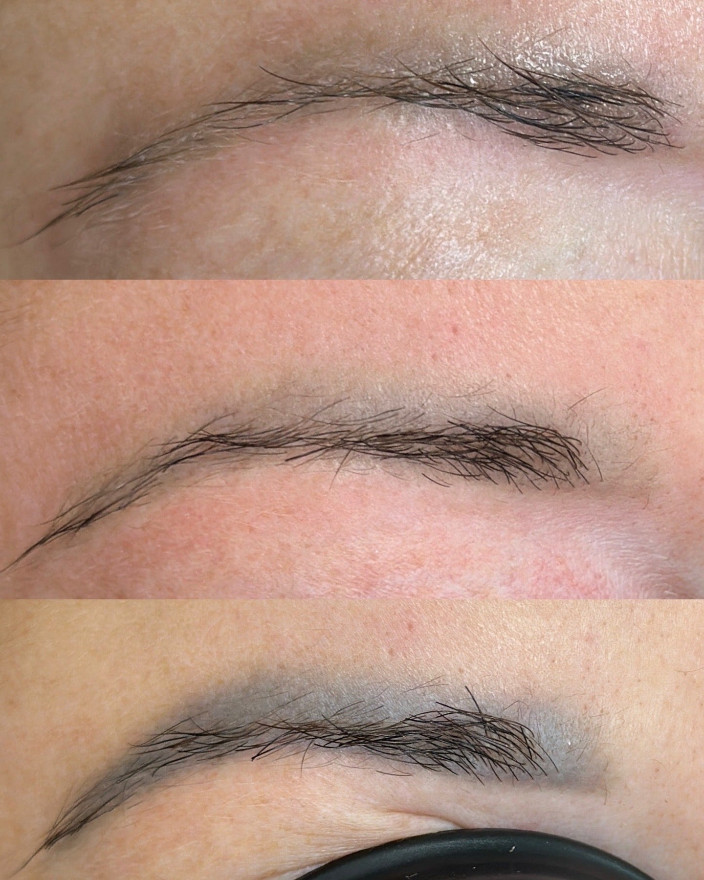 Tattoo & PMU Removal — Laser