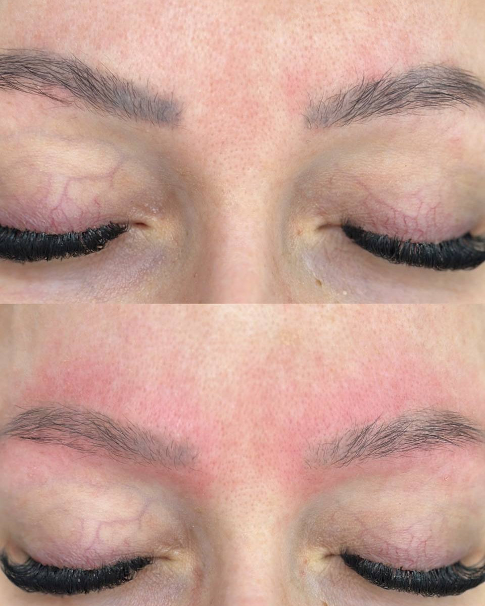 Tattoo & PMU Removal — Laser