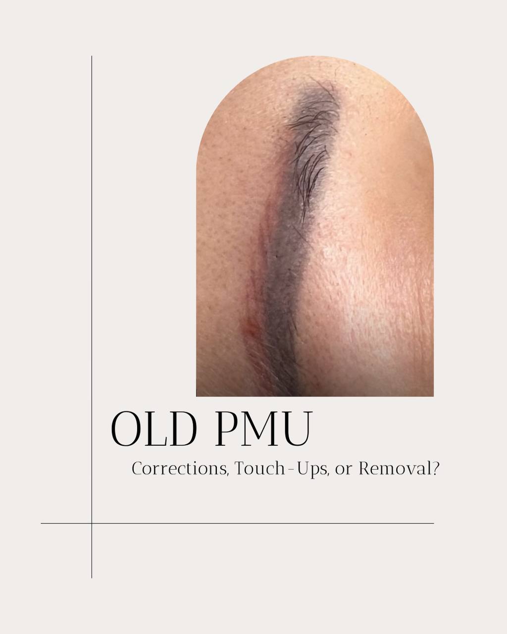 Pigment Removal — Chemical