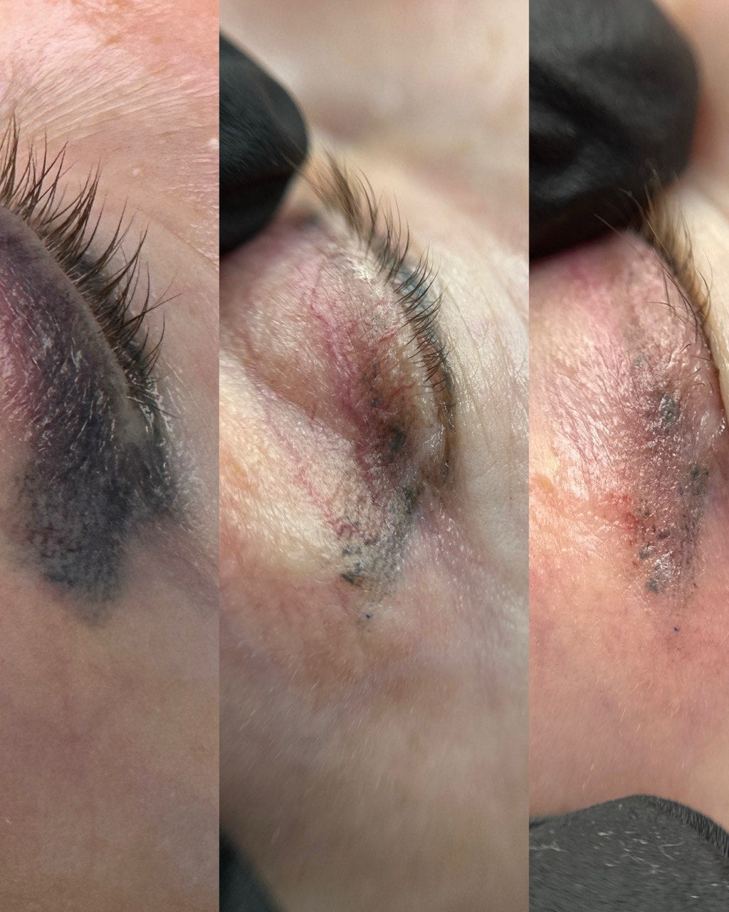 Pigment Removal Training — Non-Laser