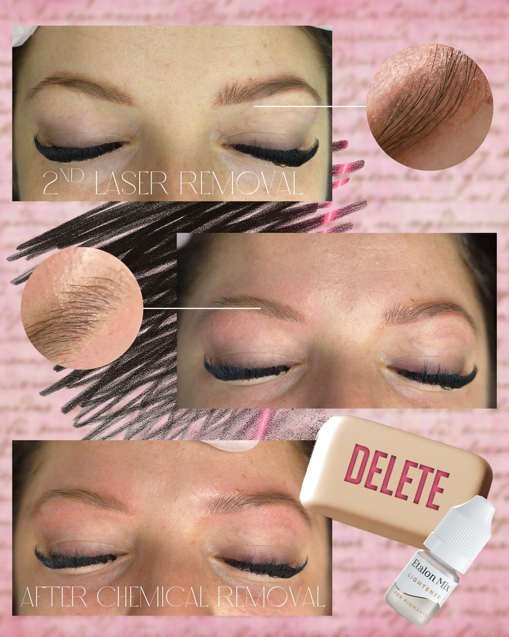 Pigment Removal Training — Non-Laser